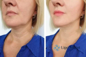 Double chin before and after Hi-Fu treatment 4 Book your double chin treatment Cannock today! We are here to help!