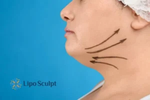 Double chin before and after Hi-Fu treatment 3 Boost your confidence with a Double chin treatment Cannock