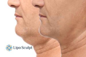 Double chin before and after Hi-Fu treatment 2 Double chin treatment Cannock from Lipo Sculpt - feel more confident today!