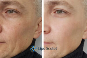 How to Fight Aging Symptoms 3 Fight Aging Symptoms Cannock With HIFU and Morpheus8 Today!