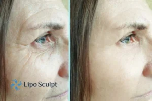 How to Fight Aging Symptoms 2 Do you want to Fight Aging Symptoms Cannock? Contact Lipo Sculpt today!