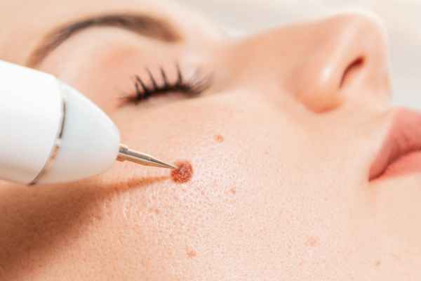 CryoPen: 5 Skin Concerns It May Be Used to Treat 3 What actually happens during a CryoPen treatment Cannock?
