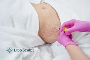 Are The Results From Aqualyx Permanent? 1 Do you want to know how long Aqualyx Cannock results last?