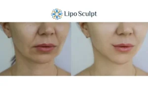 Explaining Total Skin Tightening Treatment And What It Can Do For You 2 Do you want to boost your self confidence? Give Morpheus8 Cannock a try today!