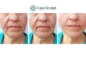 Explaining Total Skin Tightening Treatment And What It Can Do For You 3 Boost your confidence with Morpheus8 Cannock call our team today!