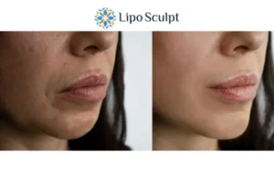 Explaining Total Skin Tightening Treatment And What It Can Do For You 4 Morpheus8 Cannock the best results - call our team today!