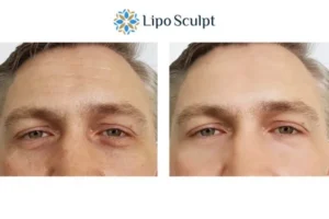 Explaining Total Skin Tightening Treatment And What It Can Do For You 6 Morpheus8 Cannock book in today to find out more!
