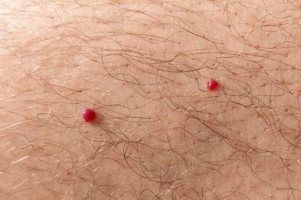 CryoPen: 5 Skin Concerns It May Be Used to Treat 2 cherry angioma removal Cannock