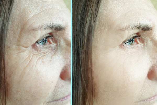 Why Do People Choose HIFU for a Non-Surgical Facelift? 4 How long can HIFU results last Cannock?
