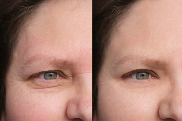 HIFU vs Botulinum Toxin: Understanding the Differences 4 How long do HIFU results last Cannock?