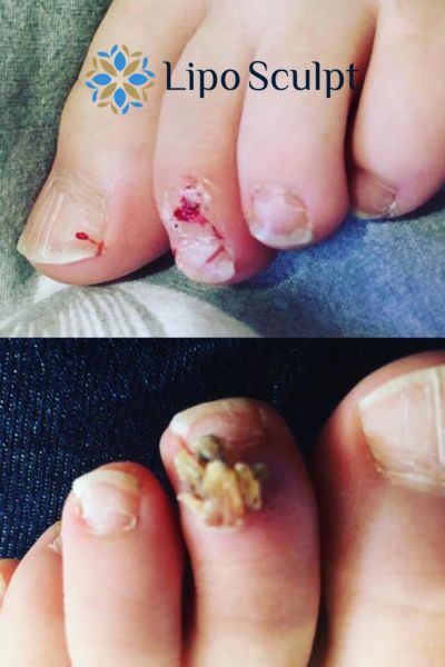 Wart removal customer results from Lipo Sculpt Cannock