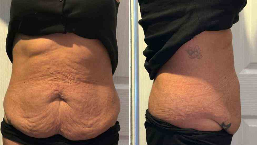 Lost the Weight but Not the Loose Skin? What You Should Know 1 Is It Definitely Loose Skin Cannock?